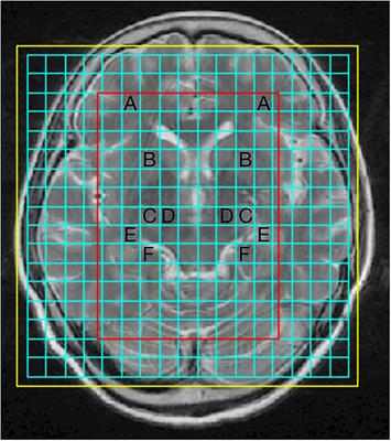 Proton Magnetic Resonance Spectroscopy for Diagnosis of Non-Motor Symptoms in Parkinson's Disease